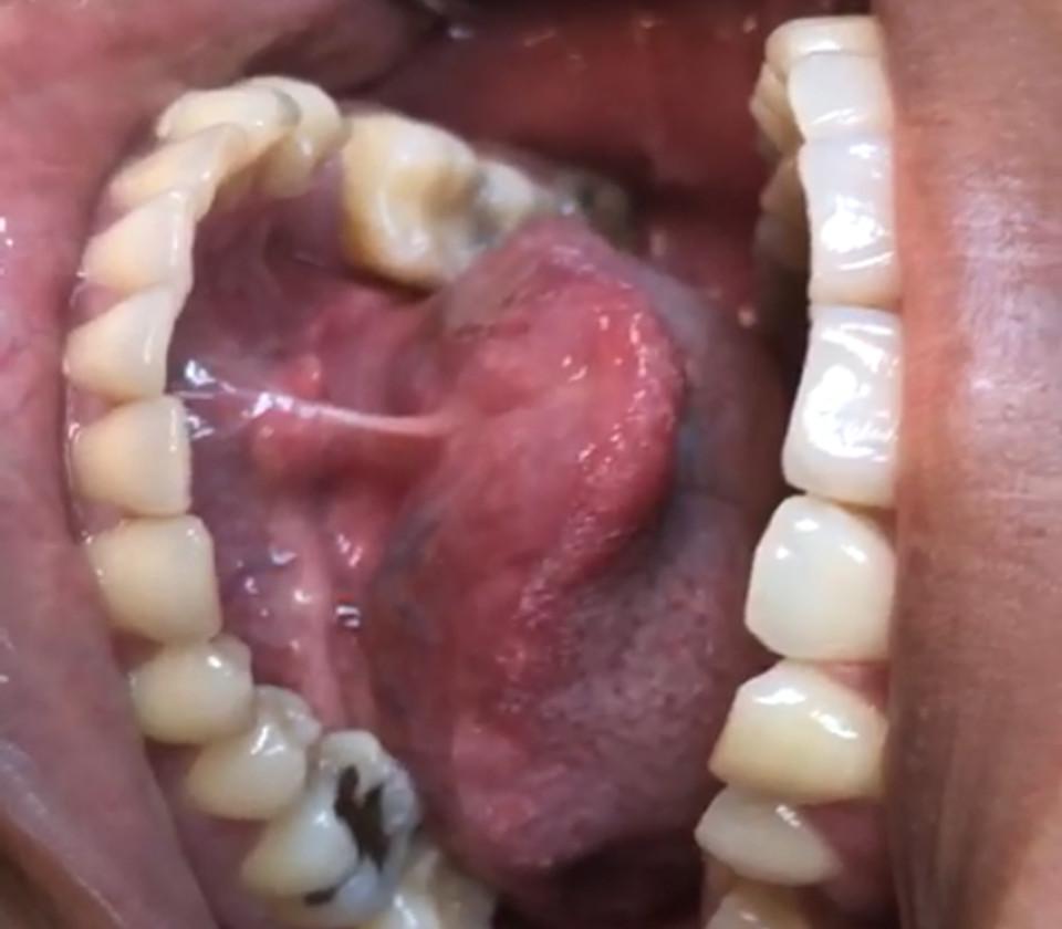 despues Cirugía de lipoma Bucal